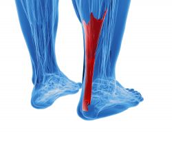 Ruptur tendon Achilles