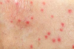 Dermatitis Herpetiformis