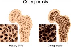 Osteoporosis