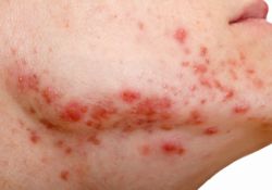 Dermatitis atopic