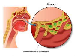 Sinusitis