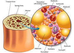 Leukemia