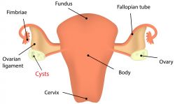 Kista Endometriosis