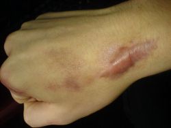 Cara Menghilangkan Keloid